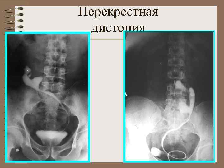 Аномалии развития почки картинки