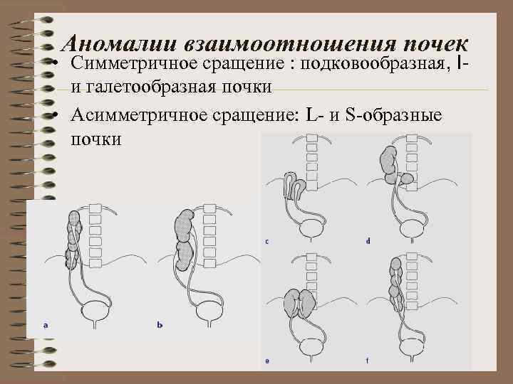 Нарушения развития почек