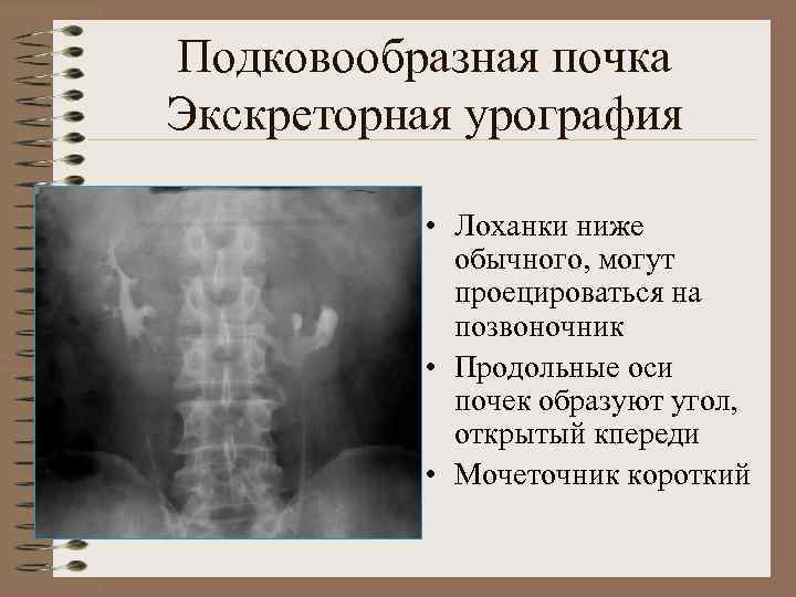 Экскреторная урография презентация