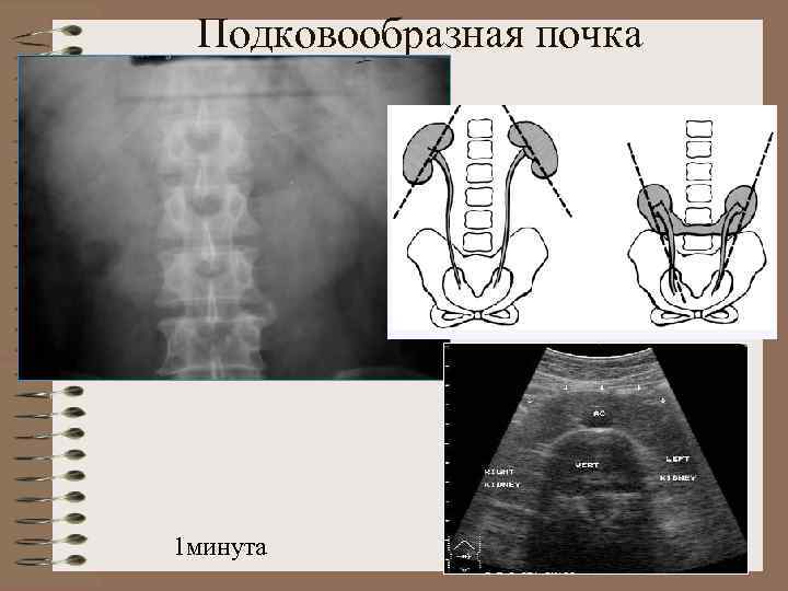 Подковообразная почка на узи фото