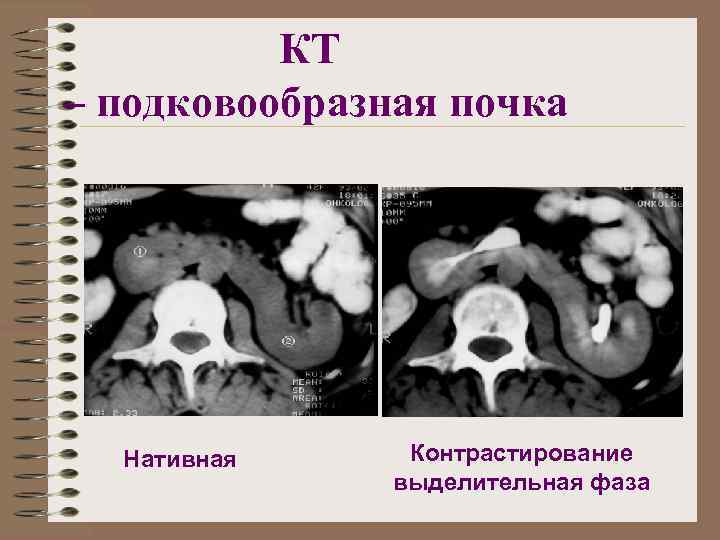 Аномалии развития почки картинки