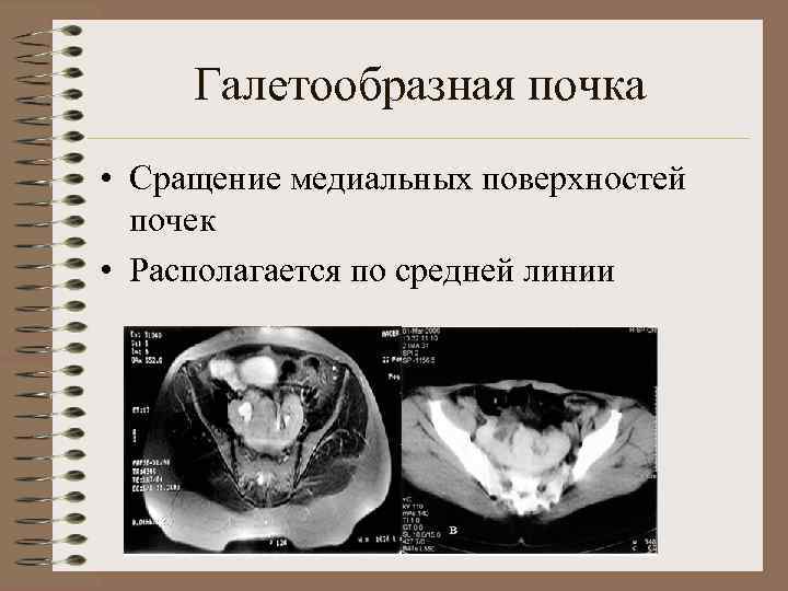 Аномалии развития почки картинки