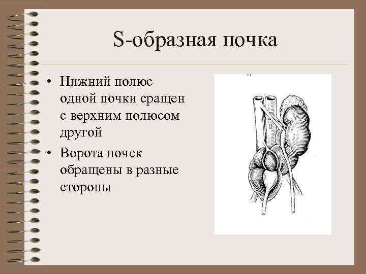 S-образная почка • Нижний полюс одной почки сращен с верхним полюсом другой • Ворота