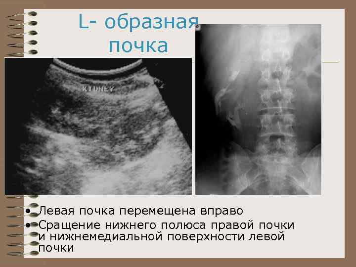 Левая почка. Аномалии сращения почек. Л образная почка на УЗИ. Л образная почка у ребенка.