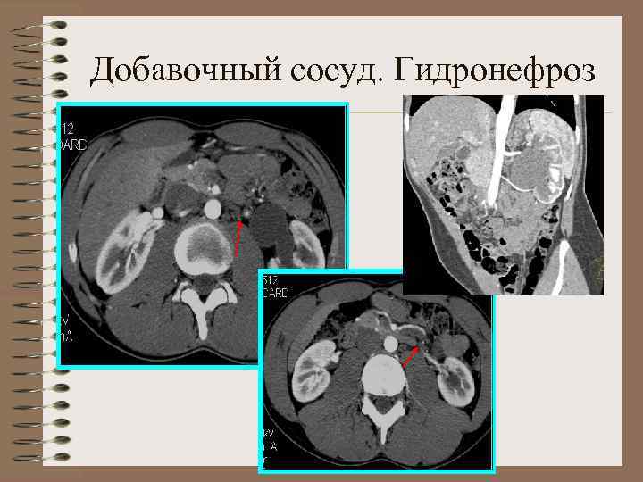 Добавочный сосуд. Гидронефроз 