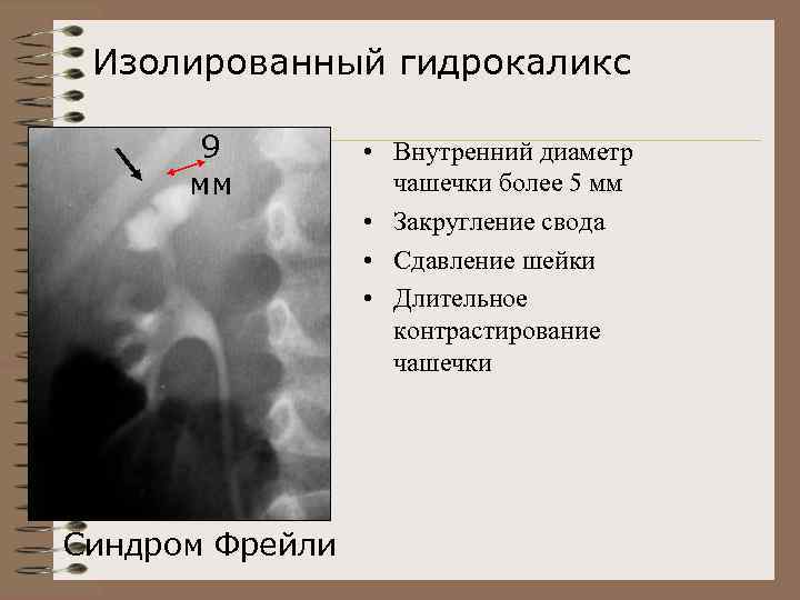 Изолированный гидрокаликс 9 мм Синдром Фрейли • Внутренний диаметр чашечки более 5 мм •