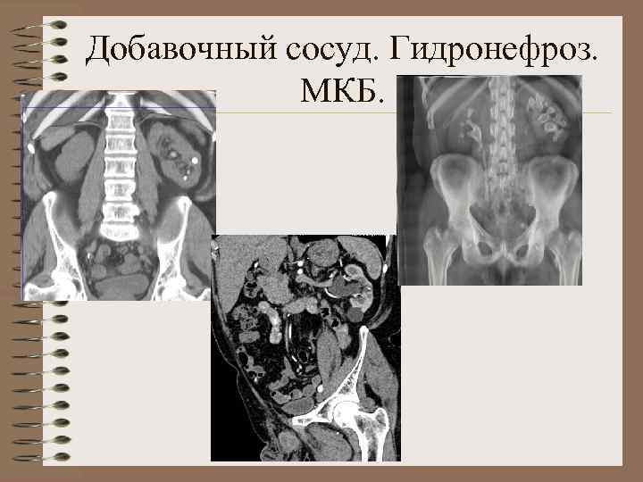 Добавочный сосуд. Гидронефроз. МКБ. 