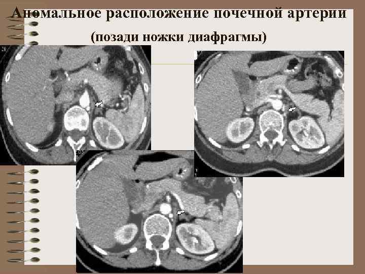 Аномальное расположение почечной артерии (позади ножки диафрагмы) 
