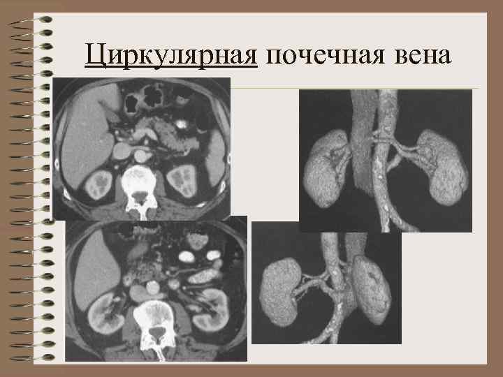 Аномалии развития почки картинки