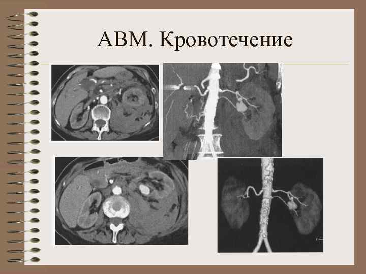 АВМ. Кровотечение 