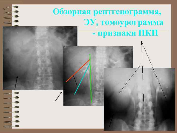 Обзорная рентгенограмма, ЭУ, томоурограмма - признаки ПКП 