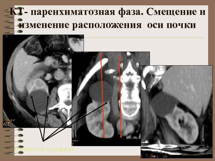 КТ- паренхиматозная фаза. Смещение и изменение расположения оси почки Симптом «клюва» 