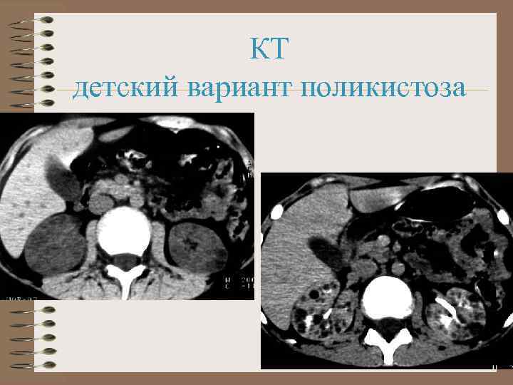КТ детский вариант поликистоза 