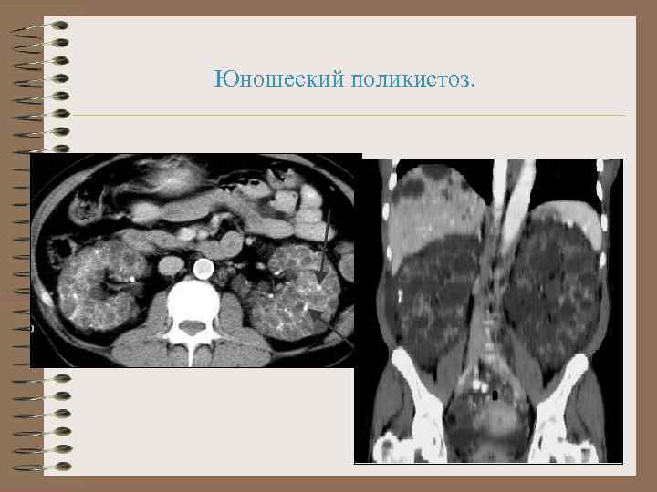 Юношеский поликистоз. 