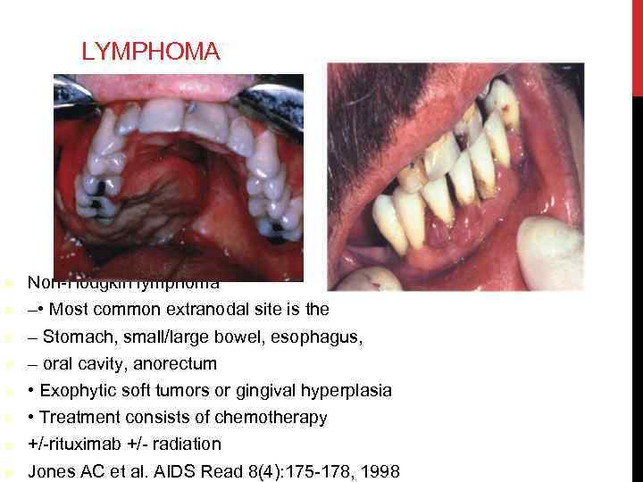 LYMPHOMA Non-Hodgkin lymphoma – • Most common extranodal site is the – Stomach, small/large
