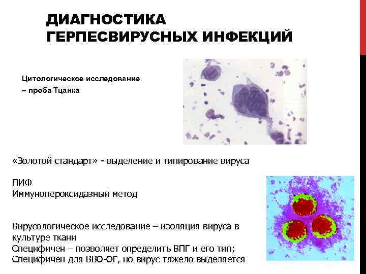 ДИАГНОСТИКА ГЕРПЕСВИРУСНЫХ ИНФЕКЦИЙ Цитологическое исследование – проба Тцанка «Золотой стандарт» - выделение и типирование