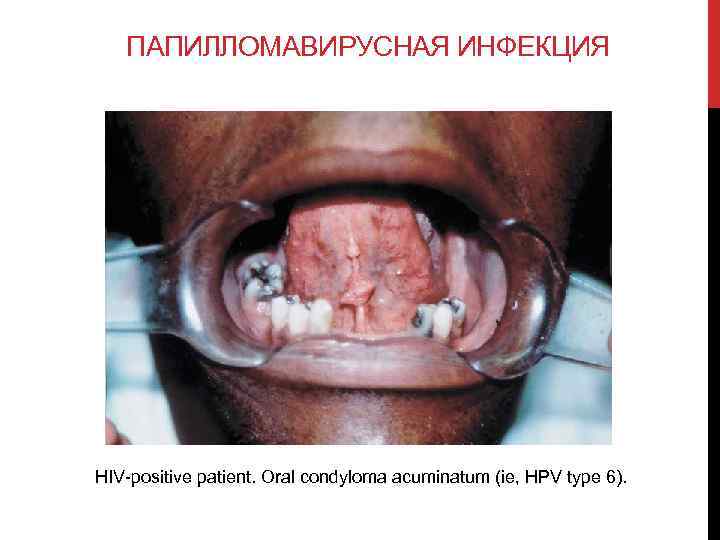 ПАПИЛЛОМАВИРУСНАЯ ИНФЕКЦИЯ HIV-positive patient. Oral condyloma acuminatum (ie, HPV type 6). 