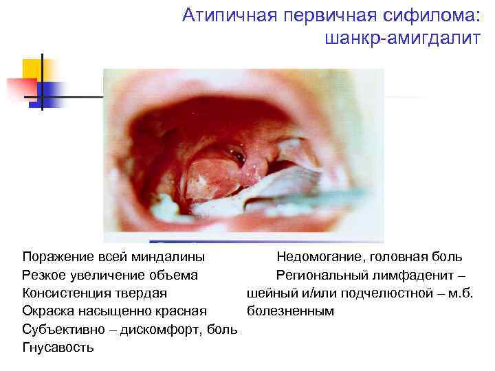 Атипичная первичная сифилома: шанкр-амигдалит Поражение всей миндалины Недомогание, головная боль Резкое увеличение объема Региональный