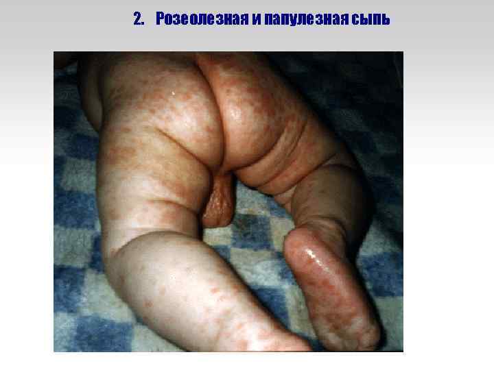2. Розеолезная и папулезная сыпь 