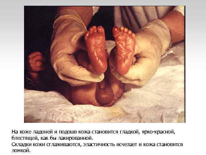  • На коже ладоней и подошв кожа становится гладкой, ярко-красной, блестящей, как бы