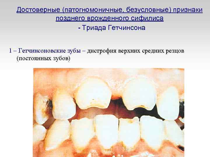 Достоверные (патогномоничные, безусловные) признаки позднего врожденного сифилиса - Триада Гетчинсона 1 – Гетчинсоновские зубы