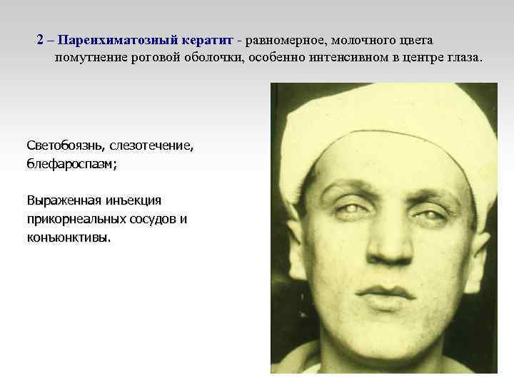 2 – Паренхиматозный кератит - равномерное, молочного цвета помутнение роговой оболочки, особенно интенсивном в