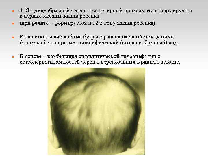  4. Ягодицеобразный череп – характерный признак, если формируется в первые месяцы жизни ребенка