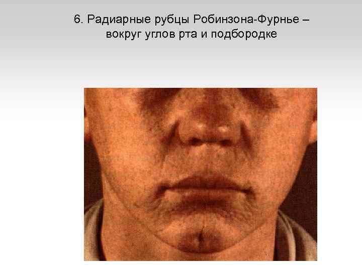 6. Радиарные рубцы Робинзона-Фурнье – вокруг углов рта и подбородке 