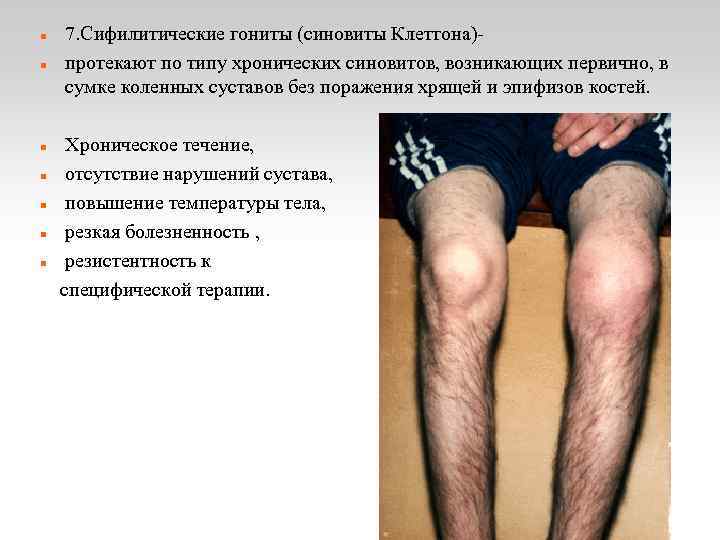  7. Сифилитические гониты (синовиты Клеттона)- протекают по типу хронических синовитов, возникающих первично, в