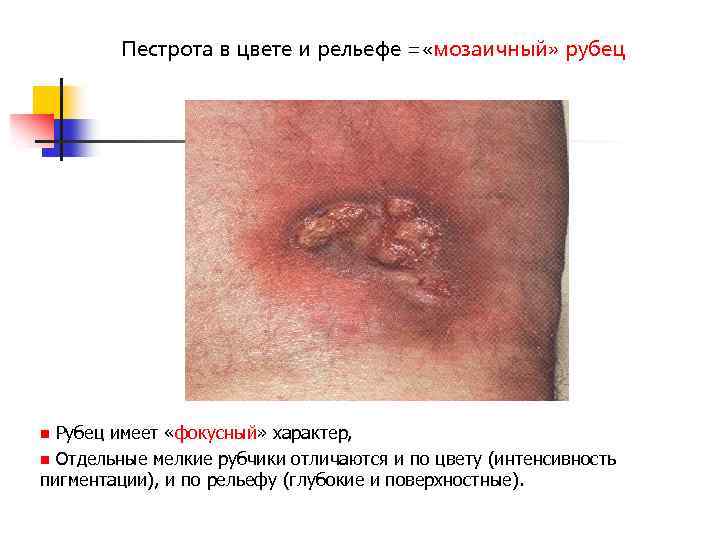 Пестрота в цвете и рельефе = «мозаичный» рубец Рубец имеет «фокусный» характер, n Отдельные