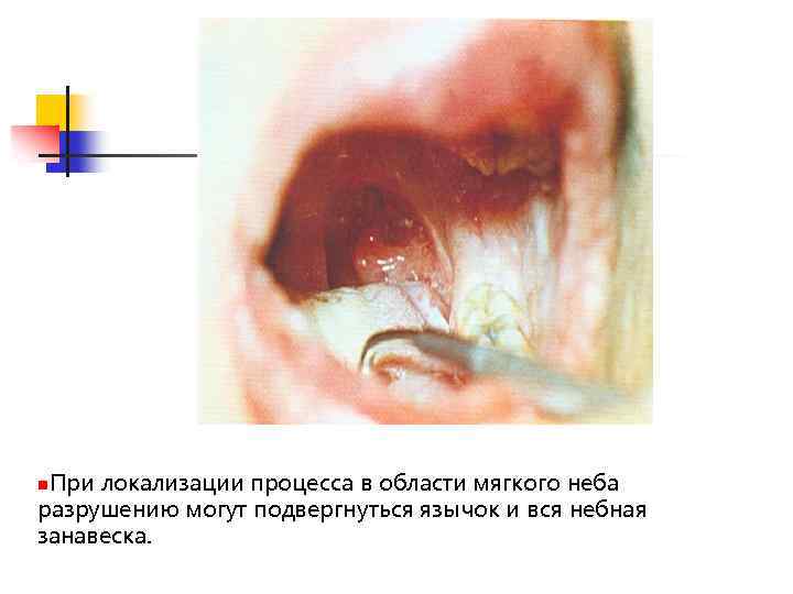 n. При локализации процесса в области мягкого неба разрушению могут подвергнуться язычок и вся