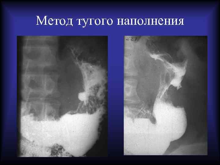Метод тугого наполнения 