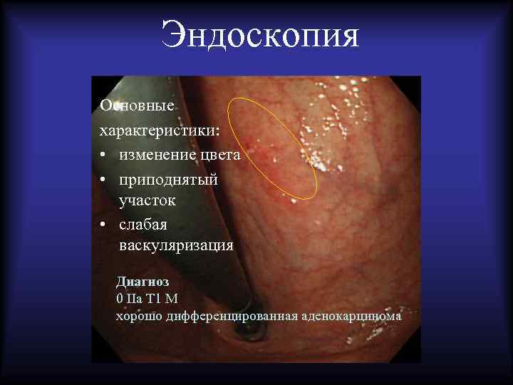 Эндоскопия Основные характеристики: • изменение цвета • приподнятый участок • слабая васкуляризация Диагноз 0