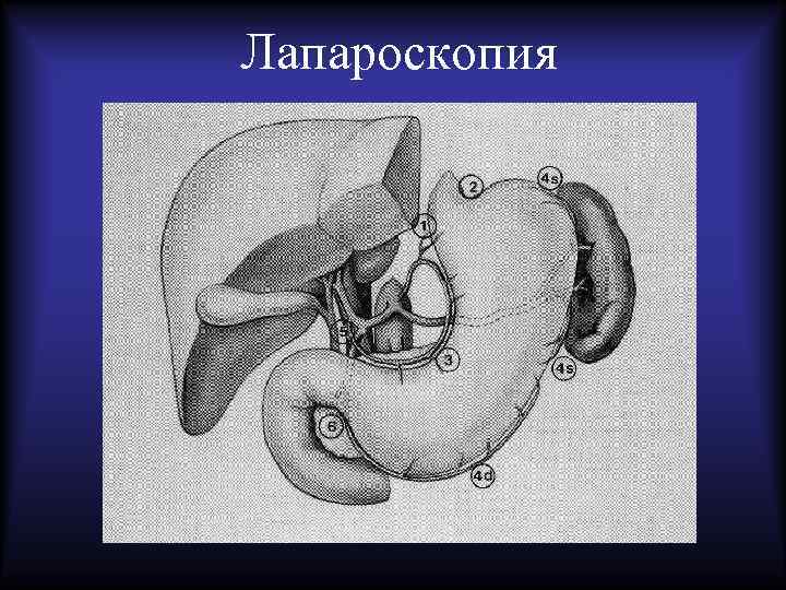 Лапароскопия 