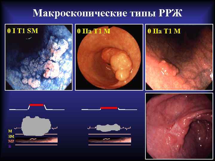Макроскопические типы РРЖ 0 I T 1 SM MP S 0 IIa T 1