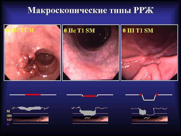 Макроскопические типы РРЖ 0 IIb T 1 M M SM MP S 0 IIc