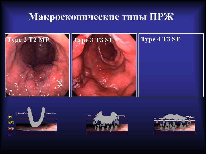 Макроскопические типы ПРЖ Type 2 T 2 MP M SM MP S Type 3