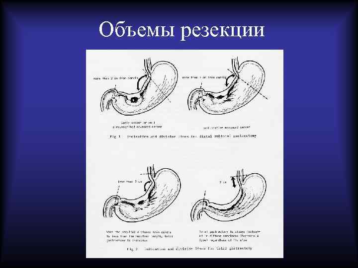 Объемы резекции 