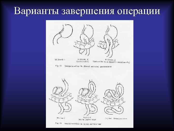 Операция окончание