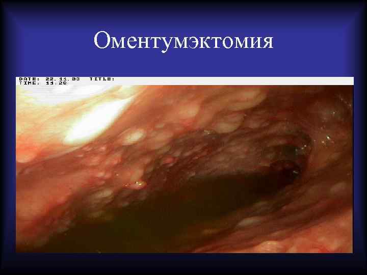 Оментумэктомия 