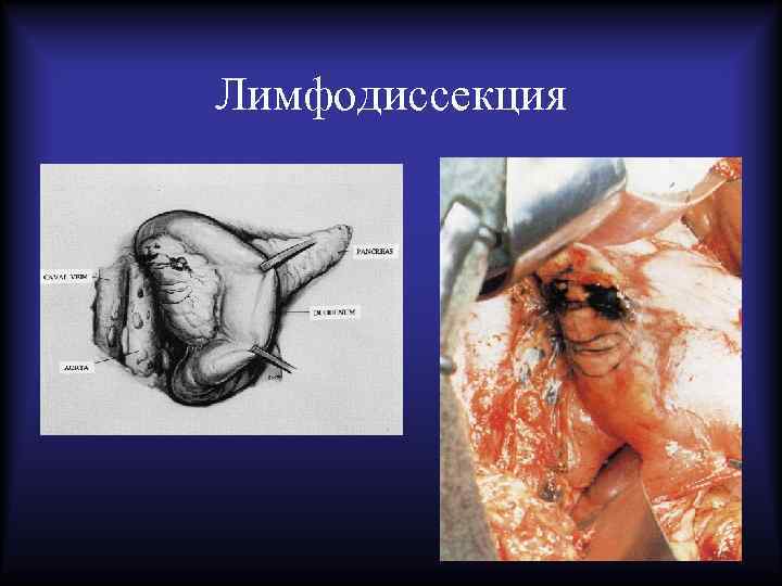 Лимфодиссекция 