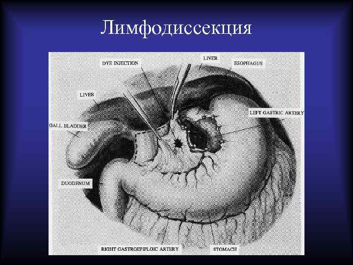 Лимфодиссекция 