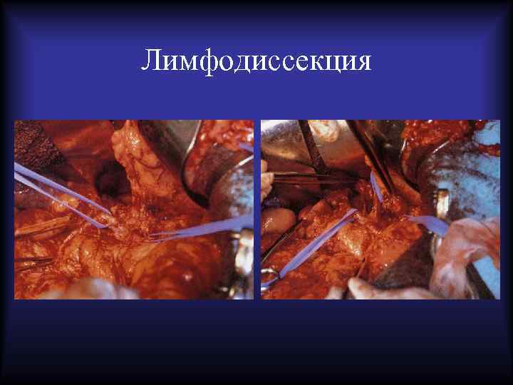 Лимфодиссекция 