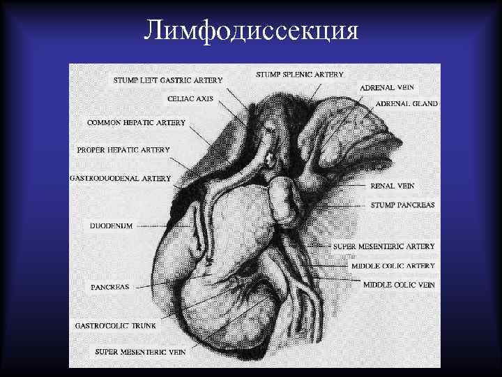 Лимфодиссекция 
