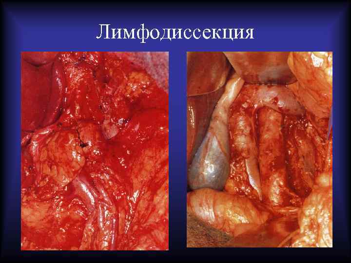 Лимфодиссекция 