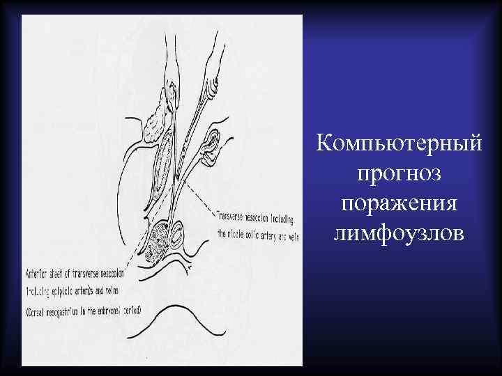 Компьютерный прогноз поражения лимфоузлов 