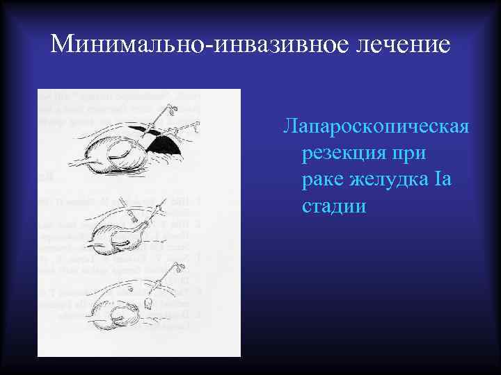 Минимально-инвазивное лечение Лапароскопическая резекция при раке желудка Iа стадии 