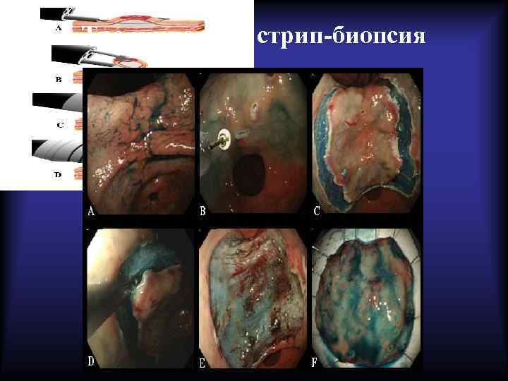 Традиционная стрип-биопсия 