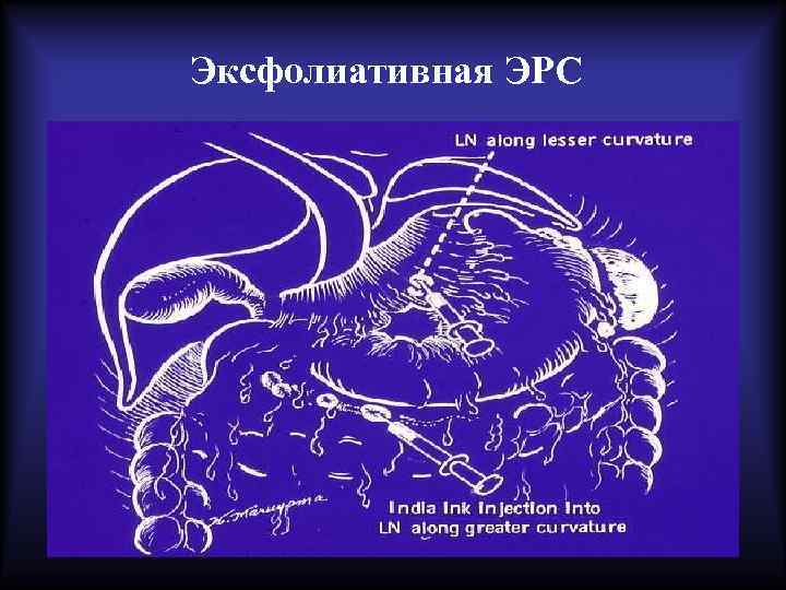 Эксфолиативная ЭРС 