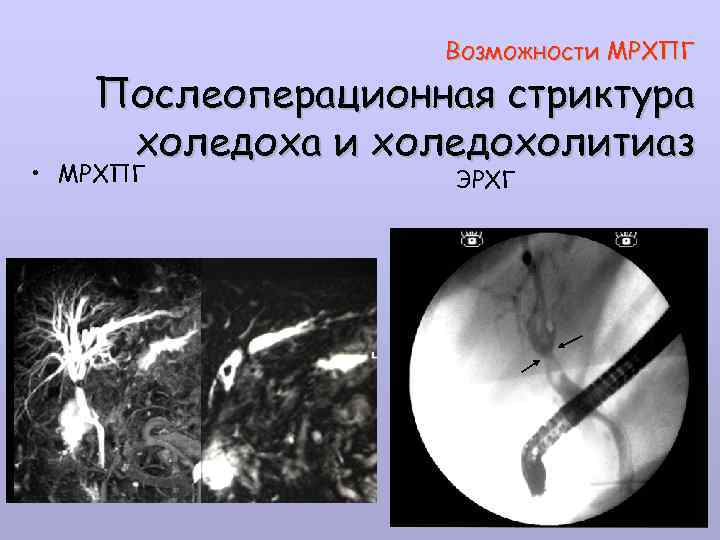 Возможности МРХПГ Послеоперационная стриктура холедоха и холедохолитиаз • МРХПГ ЭРХГ 